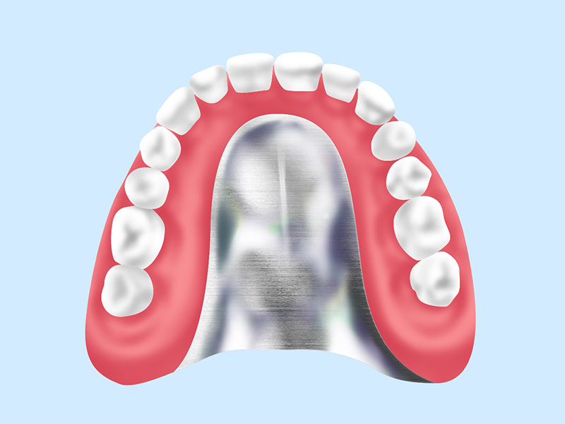 金属床義歯（コバルト）（自費診療）